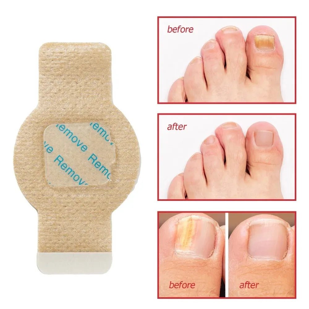 Nail Fungus Patch Waterproof Nail Repair Patch Ingrown Correction Sticker Damaged Nail Gray Care Patch Feet Care Tools - Healing Shop
