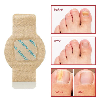 Nail Fungus Patch Waterproof Nail Repair Patch Ingrown Correction Sticker Damaged Nail Gray Care Patch Feet Care Tools - Healing Shop